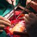 One Troponin Assay Would Suggest Whopping MI Incidence After Cardiac Surgery
