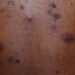 Make the Diagnosis: Is This Eruption Related to the Patient’s Acne? His Ulcerative Colitis?