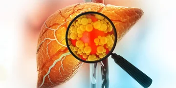 Experimental drug reverses severe fatty liver disease by repairing the gut