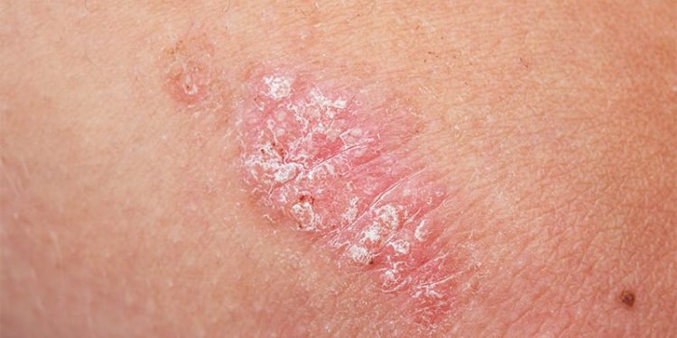 Psoriasis Workup Expanding Beyond the Skin and Joints
