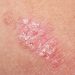 Psoriasis Workup Expanding Beyond the Skin and Joints
