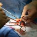 CAR T-Cell Therapy Enabled Kidney Transplant in Highly Sensitized Patients