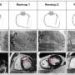 The heart’s ‘natural bypass’ that could spare patients from risky procedures