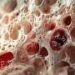 Autoimmune disease linked to poor outcomes with myelodysplastic syndrome