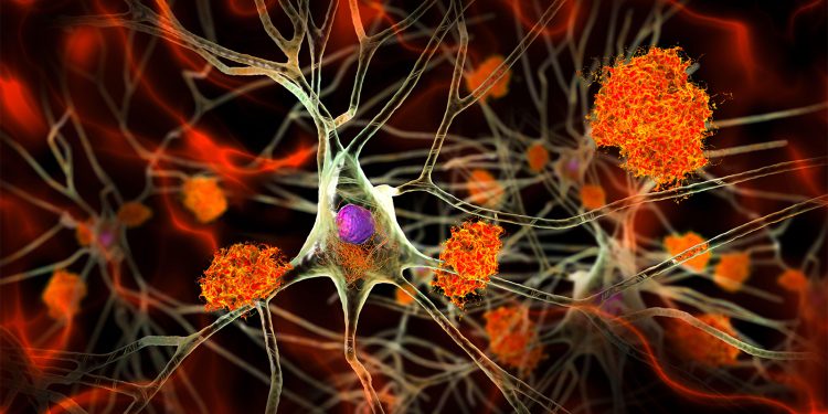 Alzheimer’s Signs Hidden in Midlife Brains, Study Shows