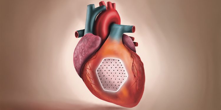Dawn of Heart Muscle Patches to Address Lost Myocardium in Heart Failure
