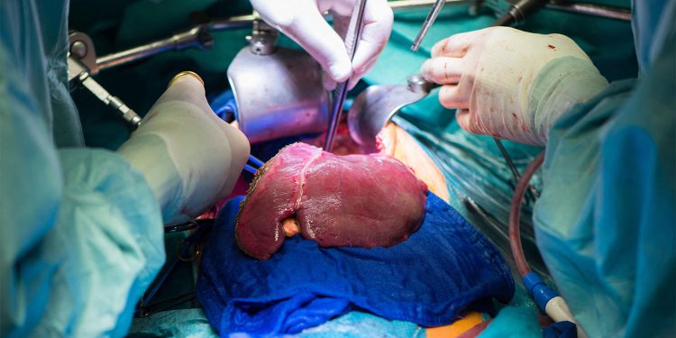 Perfusion Preservation Strategy Boosts Liver Transplant Outcomes