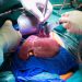 Perfusion Preservation Strategy Boosts Liver Transplant Outcomes