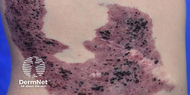 EMA Backs First Drug for Severe Overgrowth Disorders