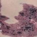 EMA Backs First Drug for Severe Overgrowth Disorders