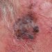 Twice-Rejected Melanoma Drug Gets Surprise Love From FDA Panel