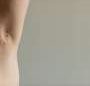 Povorcitinib beneficial for moderate-to-severe hidradenitis suppurativa