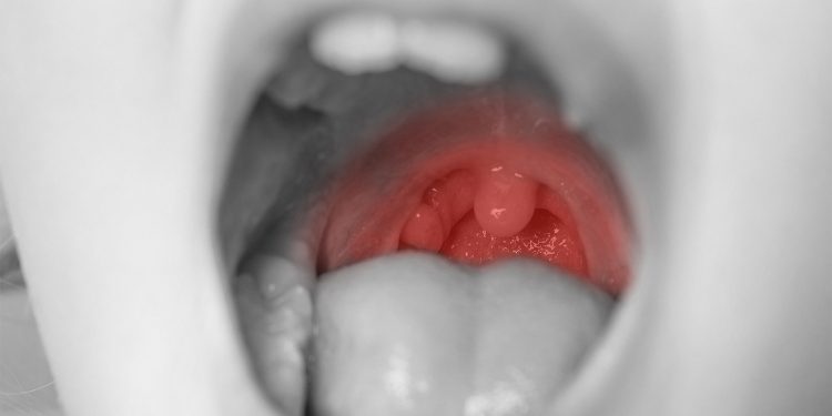 Oral Steroids After Tonsillectomy May Modestly Cut Kids’ Pain