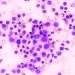 EMA Recommends New Hematology and Supportive Care Drugs