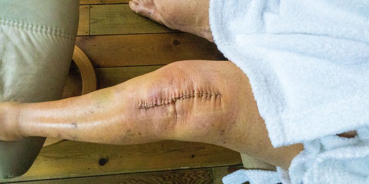Aspirin Alone Gets the Job Done for Clot Prevention After Joint Surgery