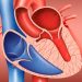 A Better Idea of When Mild HCM Is Likely to Go Downhill Fast