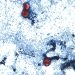 Outbreak of Cyclosporiasis Grows to More than 1,000 Cases