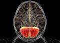 Modified Amino Acid Improves Neurologic Symptoms in Rare Genetic Disorder