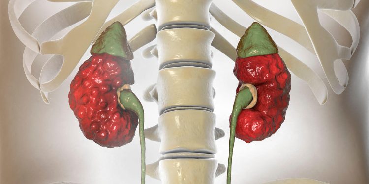 Chronic Kidney Disease  Increasingly Driven By Diabetes