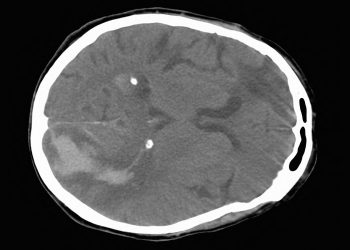ASPECTS Fails to Reflect Ceiling for Endovascular Stroke Therapy Benefit
