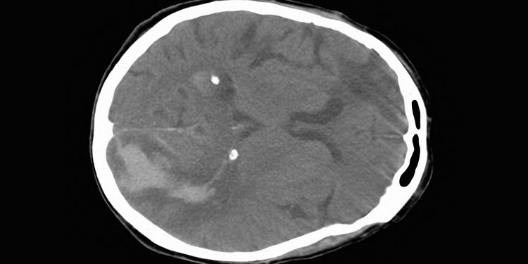 ASPECTS Fails to Reflect Ceiling for Endovascular Stroke Therapy Benefit