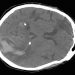 ASPECTS Fails to Reflect Ceiling for Endovascular Stroke Therapy Benefit