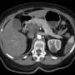 New targeted therapy shows promising early results in advanced pancreatic cancer