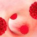 Odds of Four HPV-Linked Cancers Higher  in Transplant Recipients, HIV Patients
