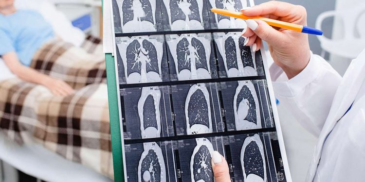 Study Homes In on Simpler Lung Cancer Screening Criteria