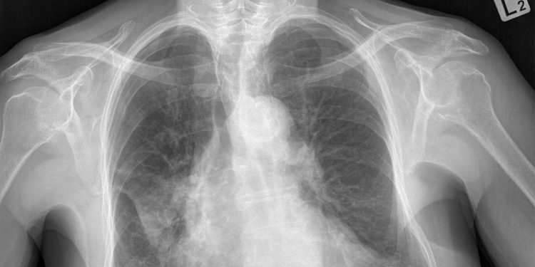 Shorter TB Regimen Matched Standard Care in Rifampicin-Resistant Disease