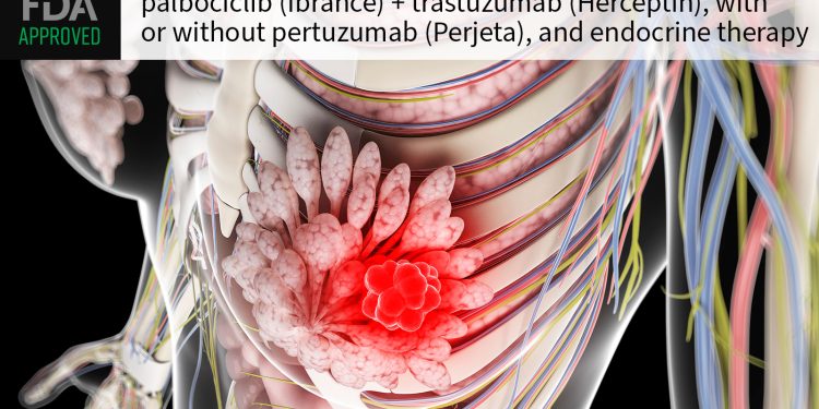FDA Approves CDK4/6 Inhibitor for HER2-Positive Breast Cancer