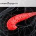 Severe Hypertriglyceridemia Drug Approved to Reduce Triglycerides, Pancreatitis Risk