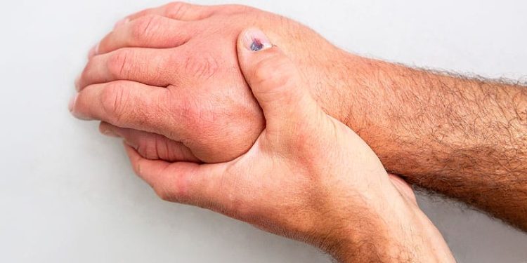 B-Cell Depletion Tied to Rituximab Response in Myopathies