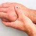 B-Cell Depletion Tied to Rituximab Response in Myopathies