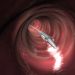 Medtronic Reflux Device Linked to 184 Serious Injuries, FDA Warns
