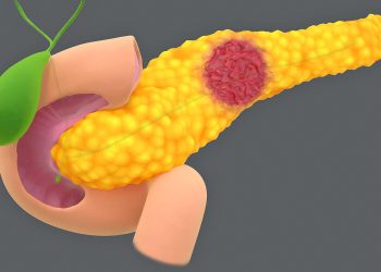 Risk of Pancreatic Cysts Becoming Cancer Grows as Worrisome Traits Increase