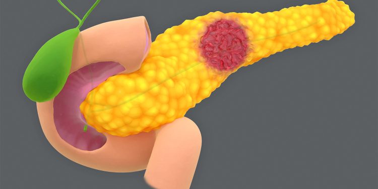 Risk of Pancreatic Cysts Becoming Cancer Grows as Worrisome Traits Increase