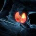 TERT Variants, Not Age, Predict Thyroid Cancer Outcomes