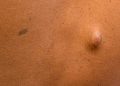 Cherry Angiomas Linked to Neurofibromatosis Type 1