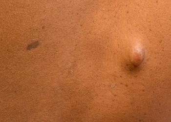 Cherry Angiomas Linked to Neurofibromatosis Type 1