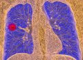 Simple Reminders Boost Lung Cancer Screening Rates