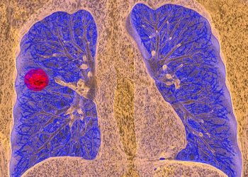Simple Reminders Boost Lung Cancer Screening Rates