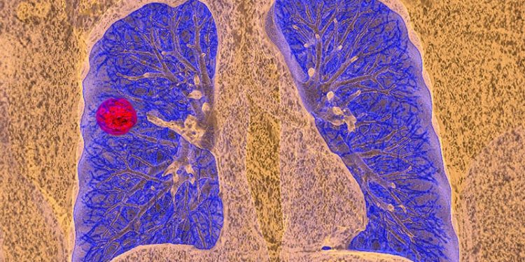 Simple Reminders Boost Lung Cancer Screening Rates