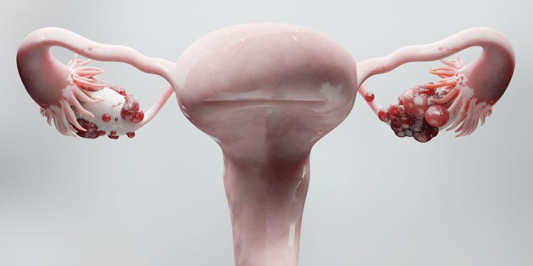 Residential Context Matters in Ovarian Cancer Survival