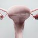 Residential Context Matters in Ovarian Cancer Survival