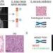 Protein ‘switch’ determines whether liposarcoma cells will become aggressive