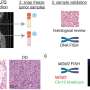 Protein ‘switch’ determines whether liposarcoma cells will become aggressive