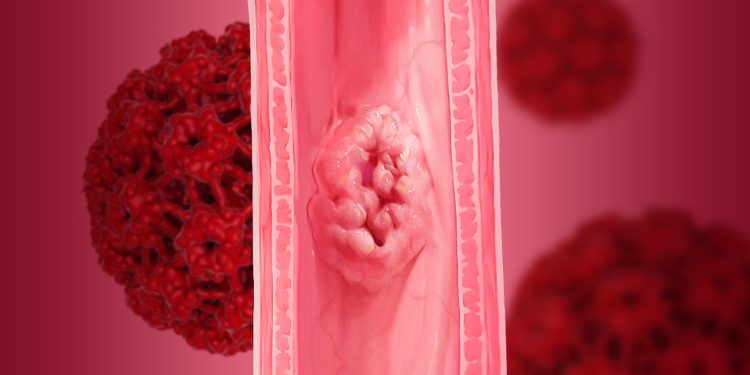 HPV Infection and Esophageal Cancer