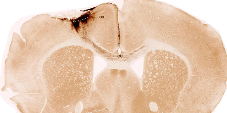 Stem cells reverse stroke damage and restore movement in mice