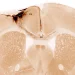 Stem cells reverse stroke damage and restore movement in mice
